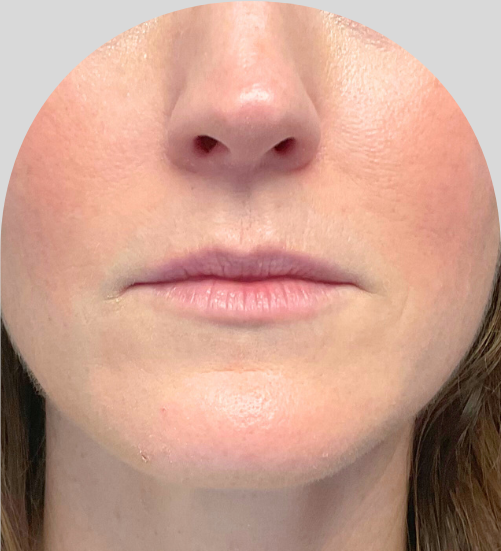 Lip Fillers - Case 54237 - Before