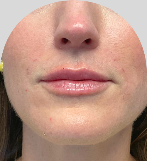 Lip Fillers - Case 54237 - After