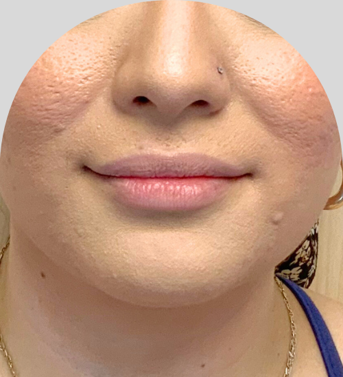 Lip Fillers - Case 54241 - Before