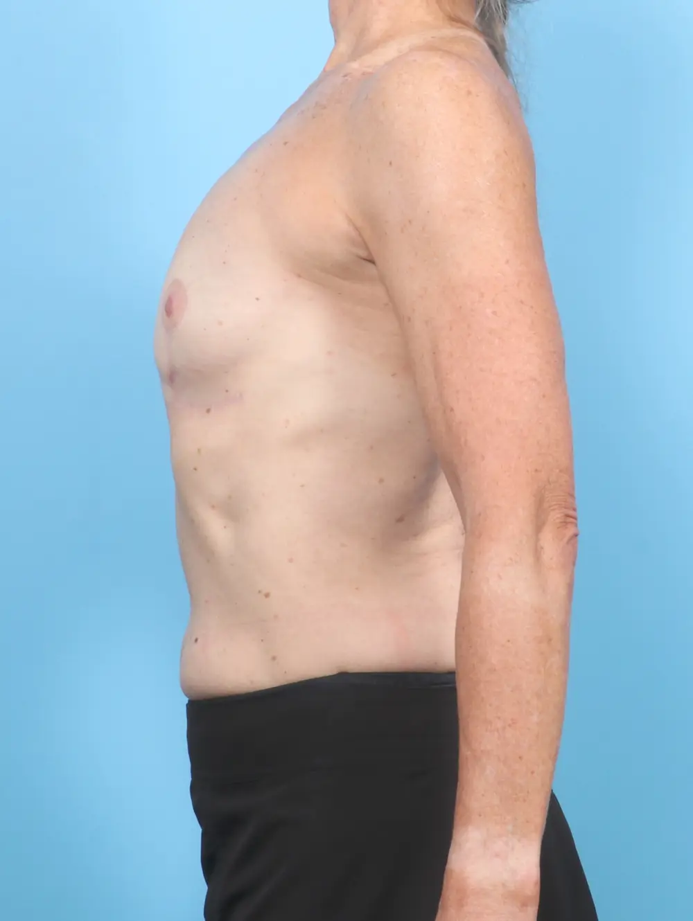 Breast Implant Removal Patient Photo - Case 54259 - after view-2
