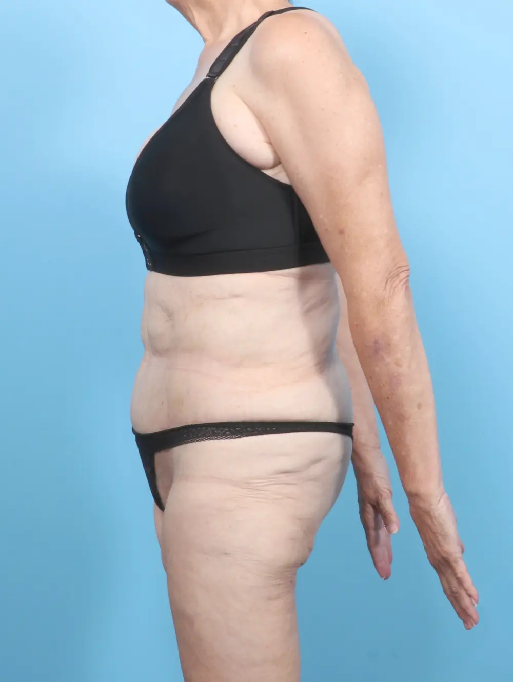 Tummy Tuck Patient Photo - Case 54267 - after view-2