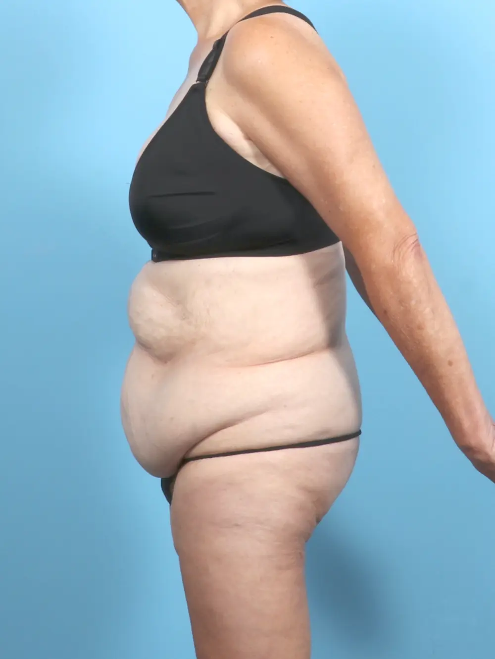 Tummy Tuck Patient Photo - Case 54267 - before view-2