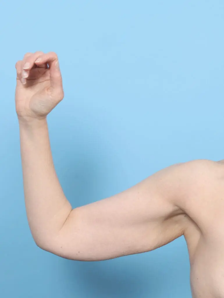 Arm Lift - Case 54335 - Before