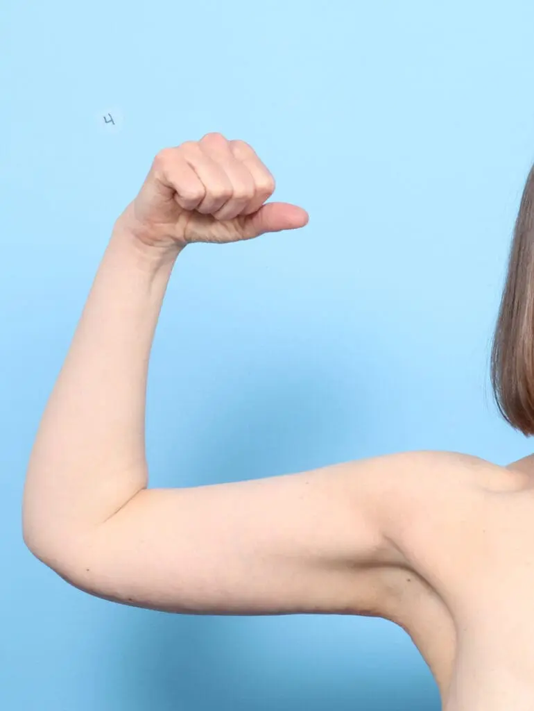 Arm Lift - Case 54335 - After