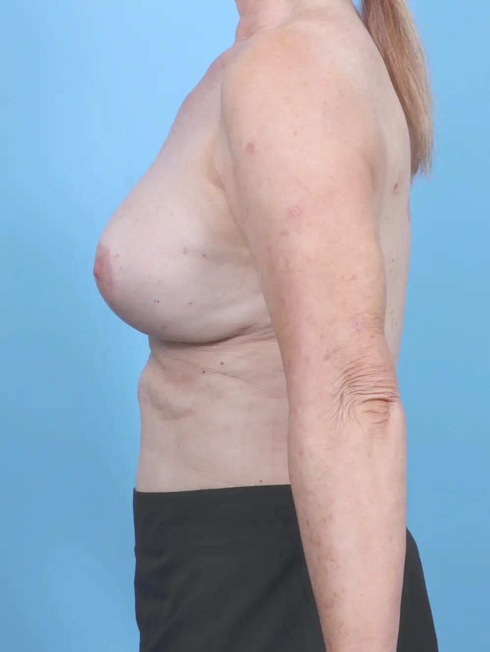 Breast Implant Revision Patient Photo - Case 54349 - after view-2