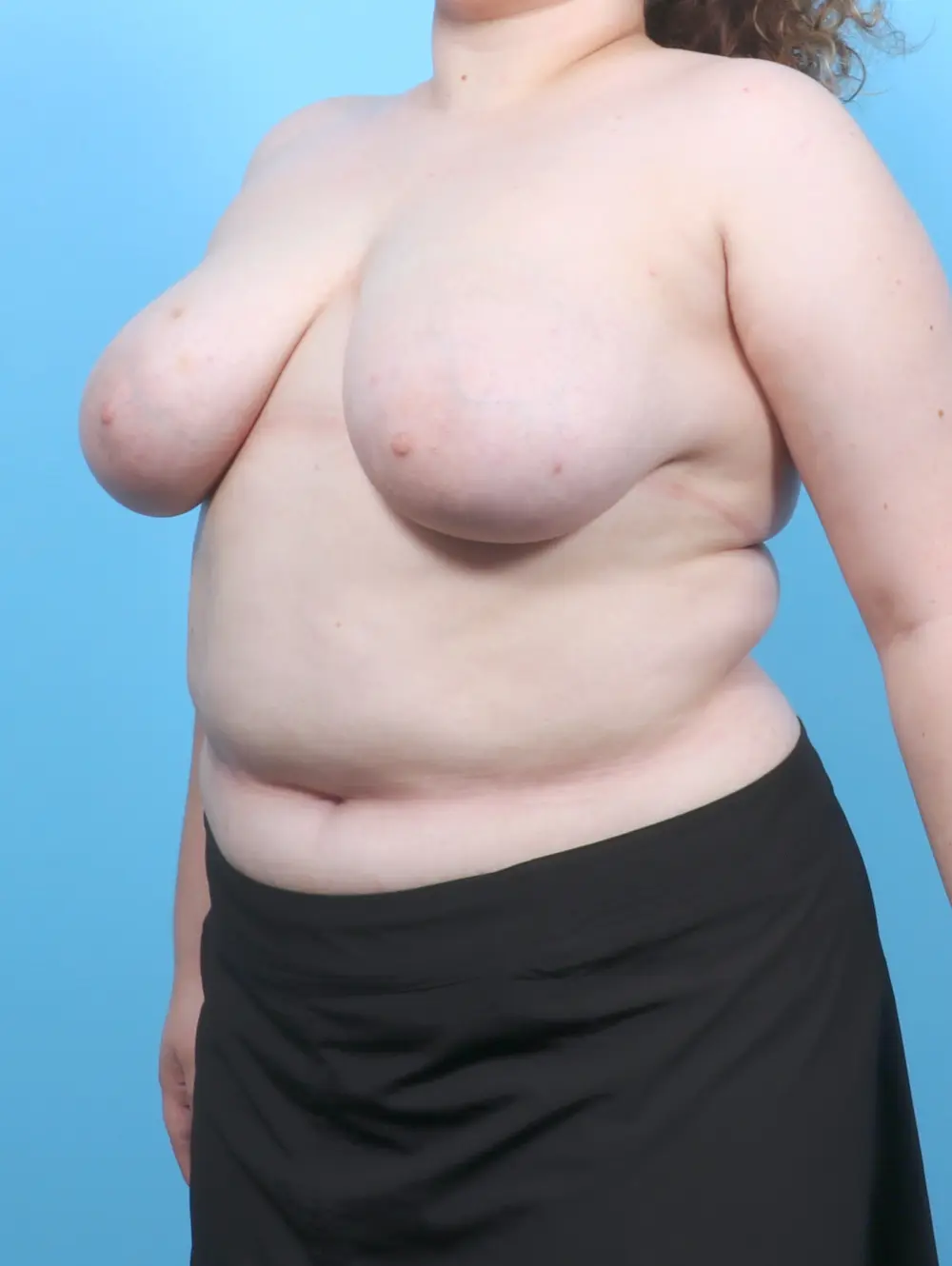 Breast Lift/Reduction w/o Implants Patient Photo - Case 54371 - before view-1