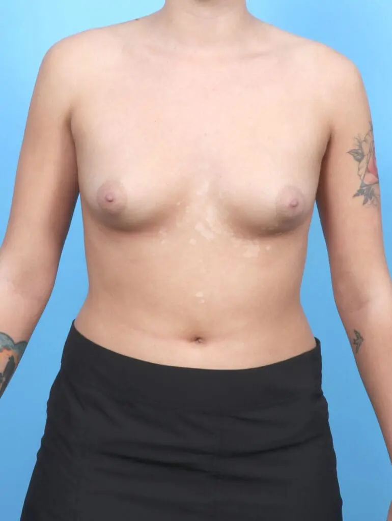Breast Augmentation - Case 54441 - Before