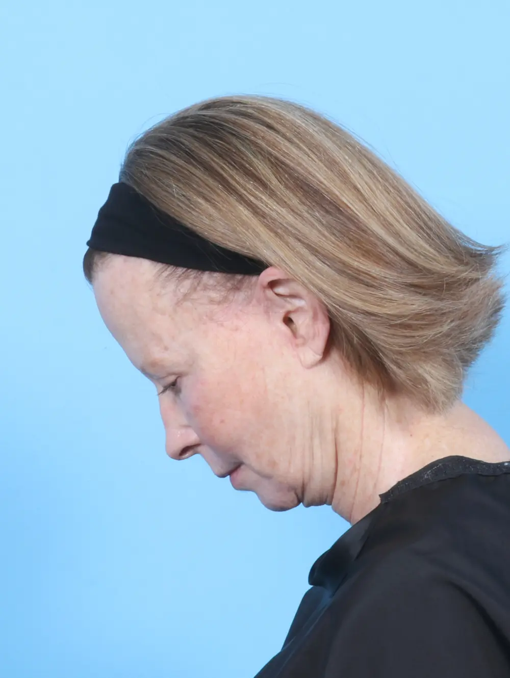 Eyelid Surgery Patient Photo - Case 54449 - after view-3