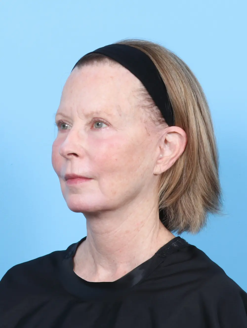 Eyelid Surgery Patient Photo - Case 54449 - after view-1