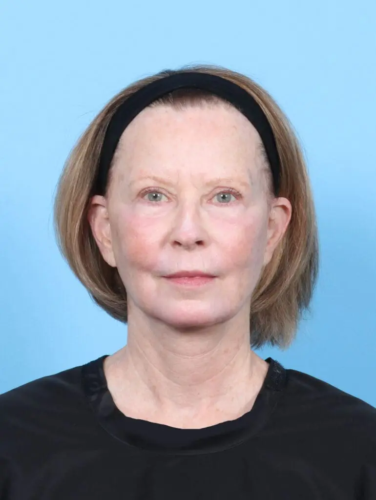 Eyelid Surgery - Case 54449 - After