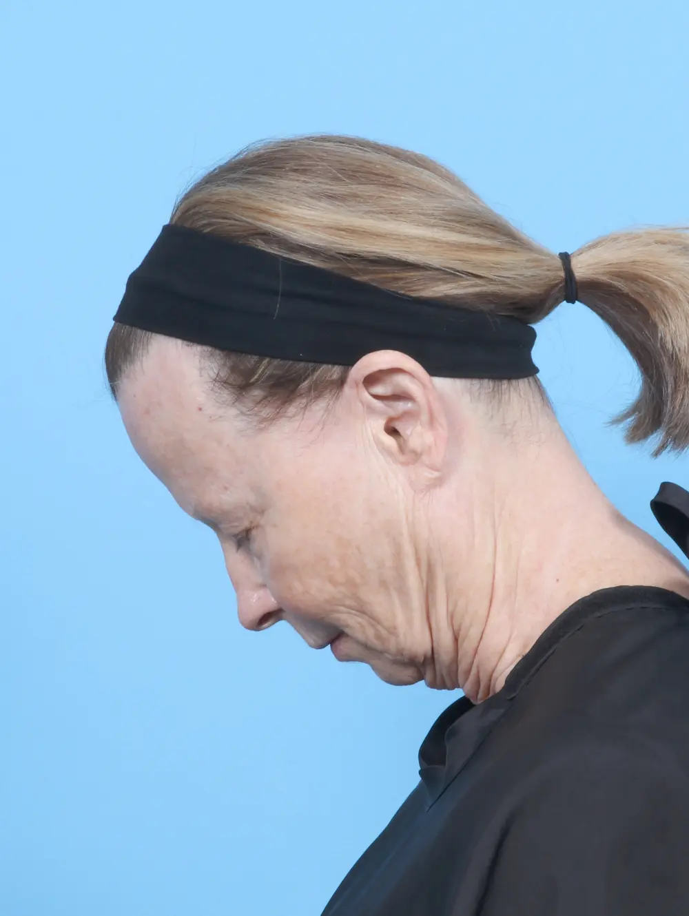 Eyelid Surgery Patient Photo - Case 54449 - before view-3