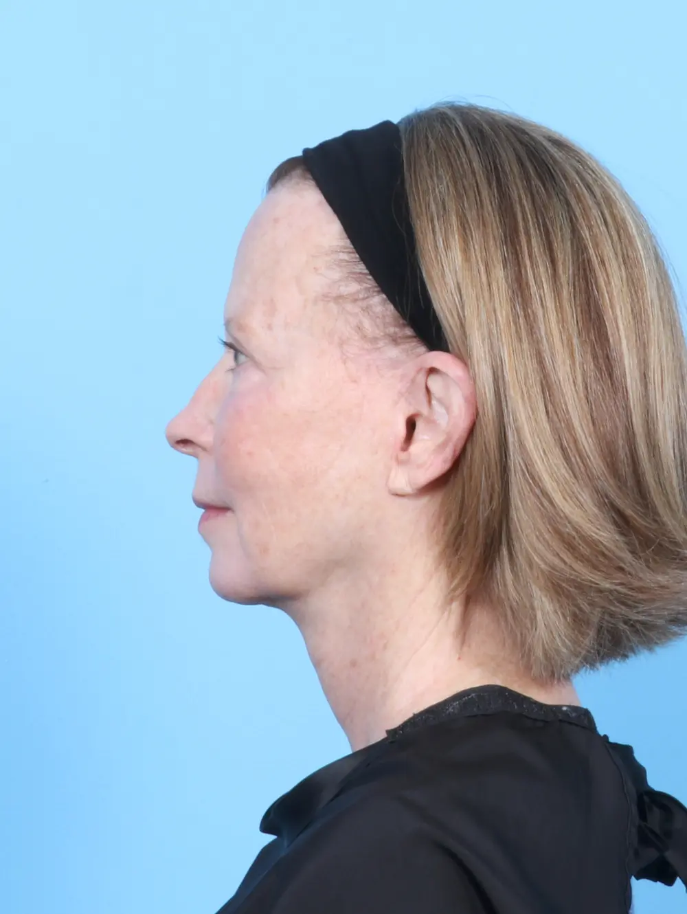 Eyelid Surgery Patient Photo - Case 54449 - after view-2