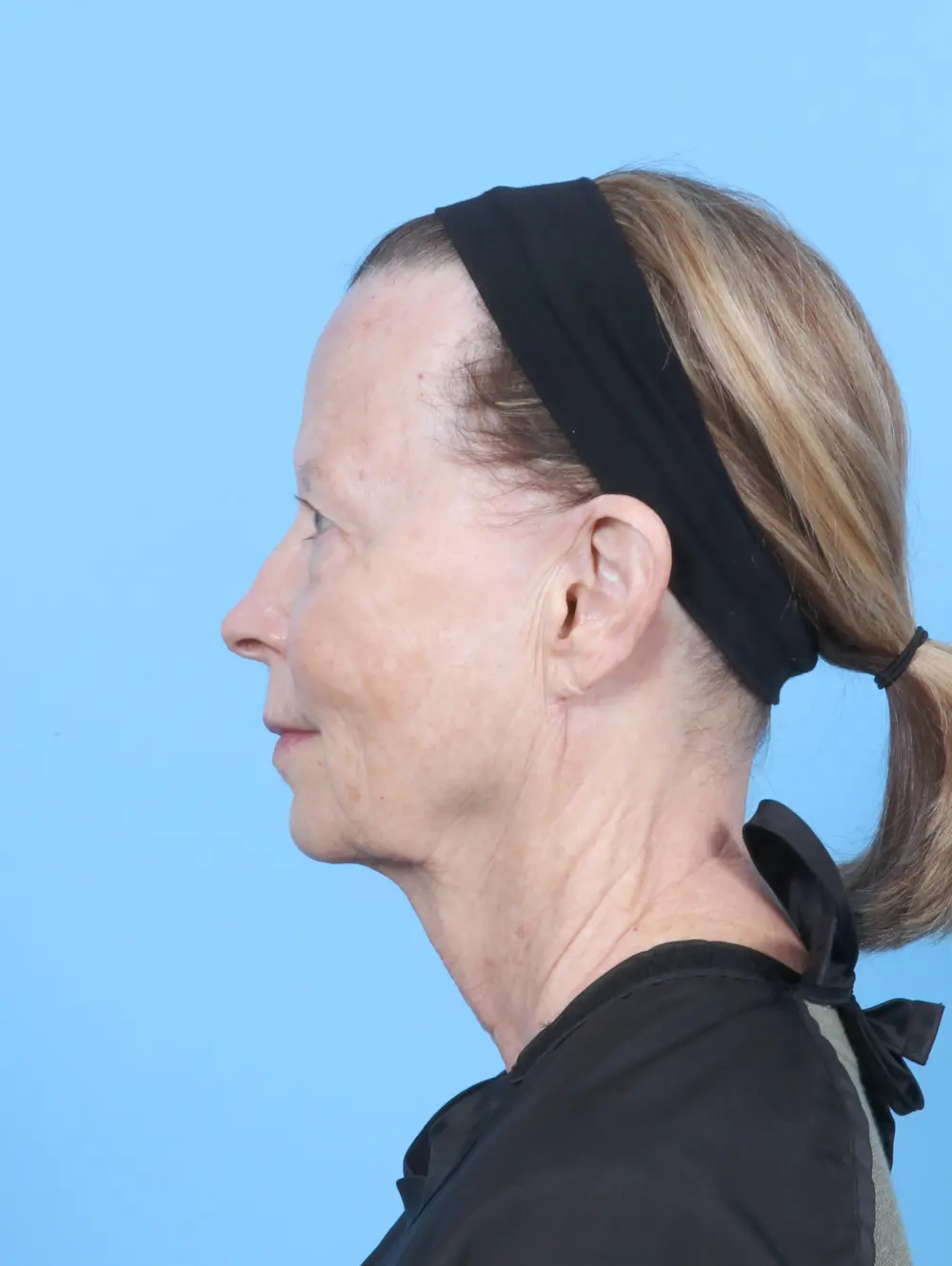 Eyelid Surgery Patient Photo - Case 54449 - before view-2