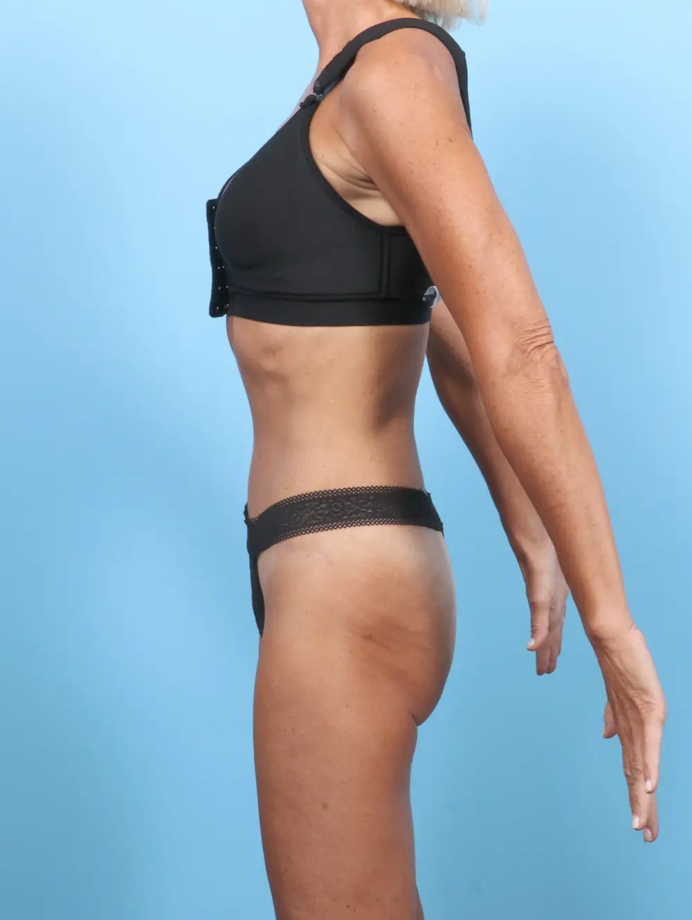Tummy Tuck Patient Photo - Case 54476 - after view-2
