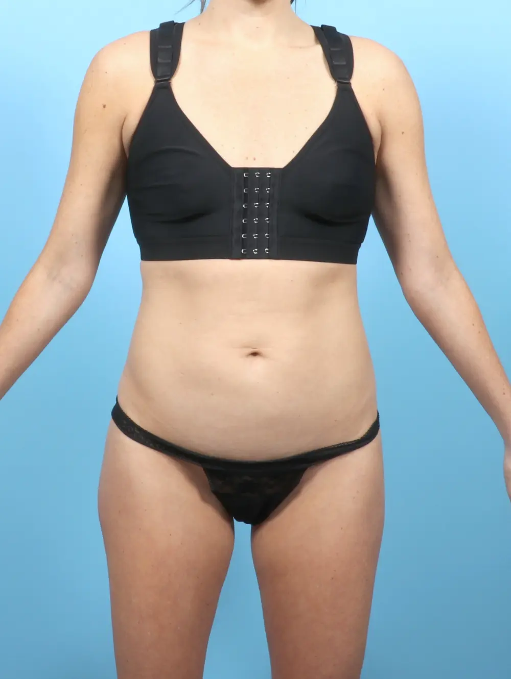 Tummy Tuck Patient Photo - Case 54526 - before view-