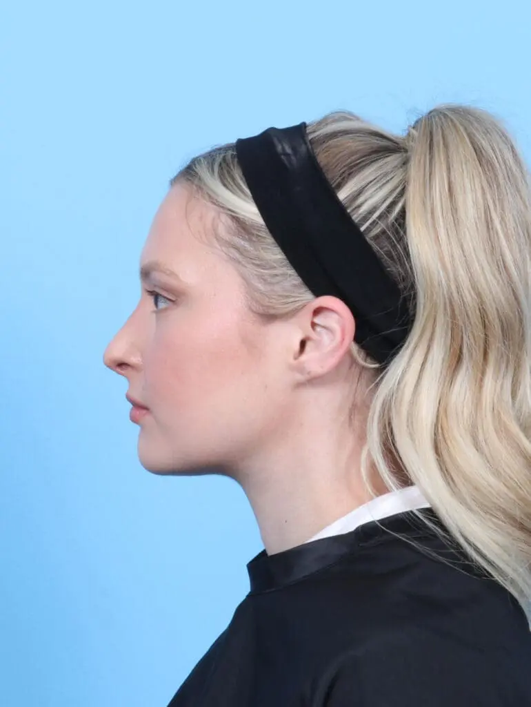 Rhinoplasty - Case 54542 - After