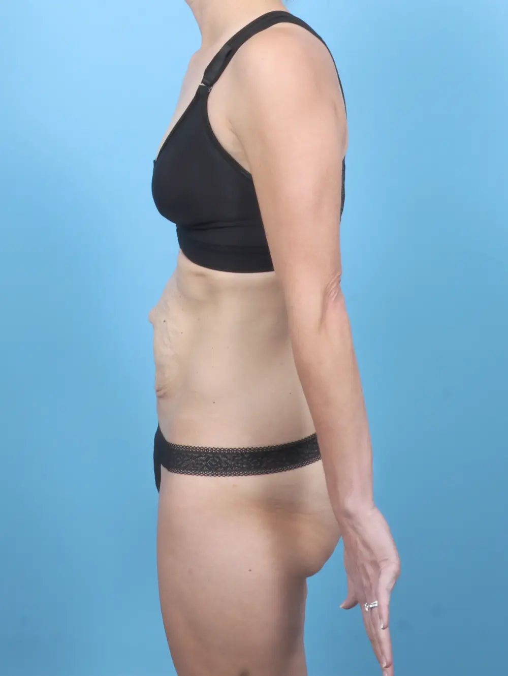 Tummy Tuck Patient Photo - Case 54612 - before view-2