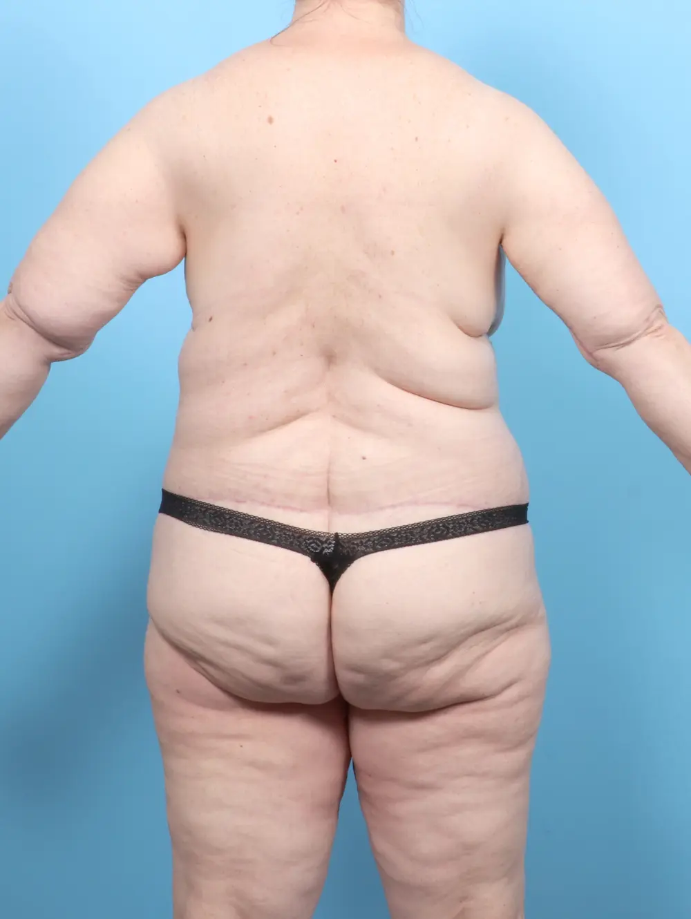 After Weight Loss Patient Photo - Case 54676 - after view-3