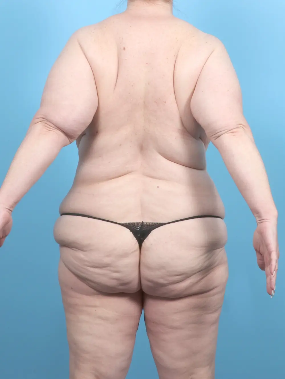 After Weight Loss Patient Photo - Case 54676 - before view-3