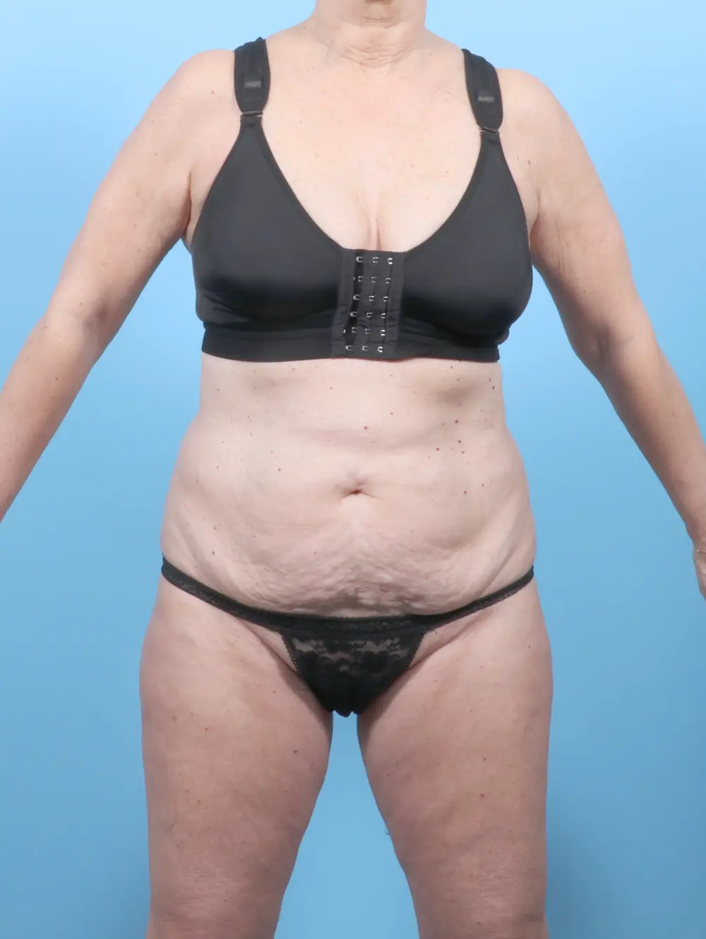 Tummy Tuck Patient Photo - Case 54732 - before view-