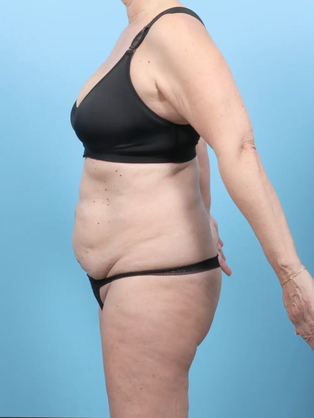 Tummy Tuck Patient Photo - Case 54732 - before view-2