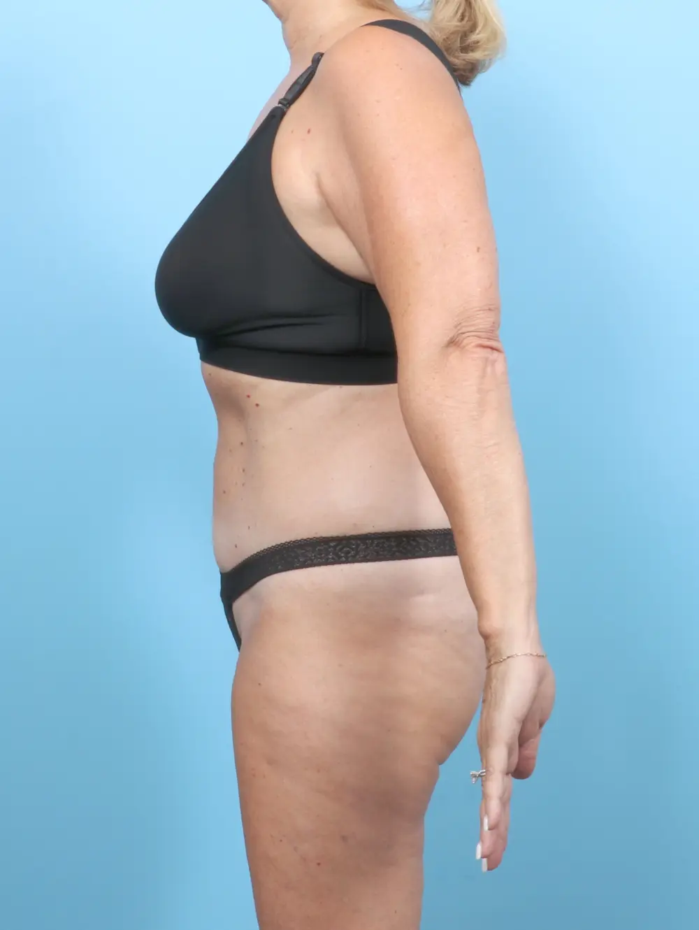 Tummy Tuck Patient Photo - Case 54732 - after view-2