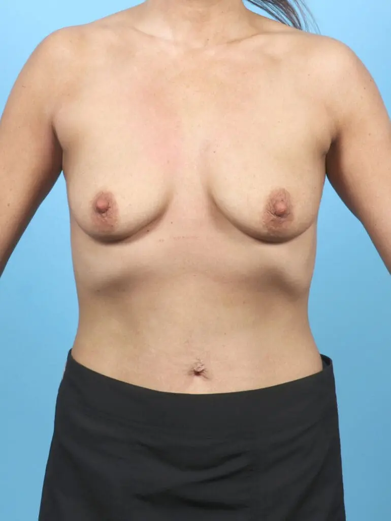Breast Lift/Reduction with Implants - Case 54740 - Before