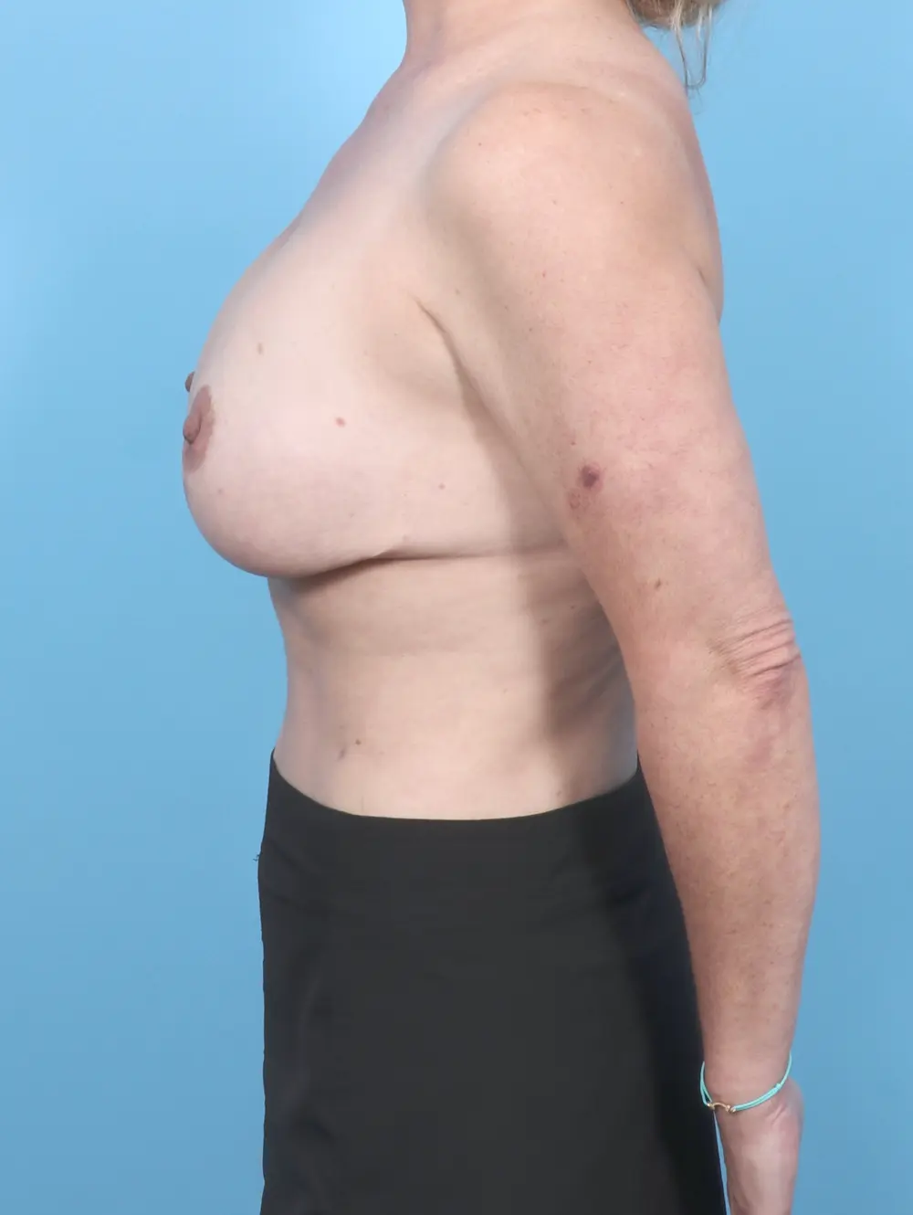 Breast Implant Removal Patient Photo - Case 54785 - before view-2