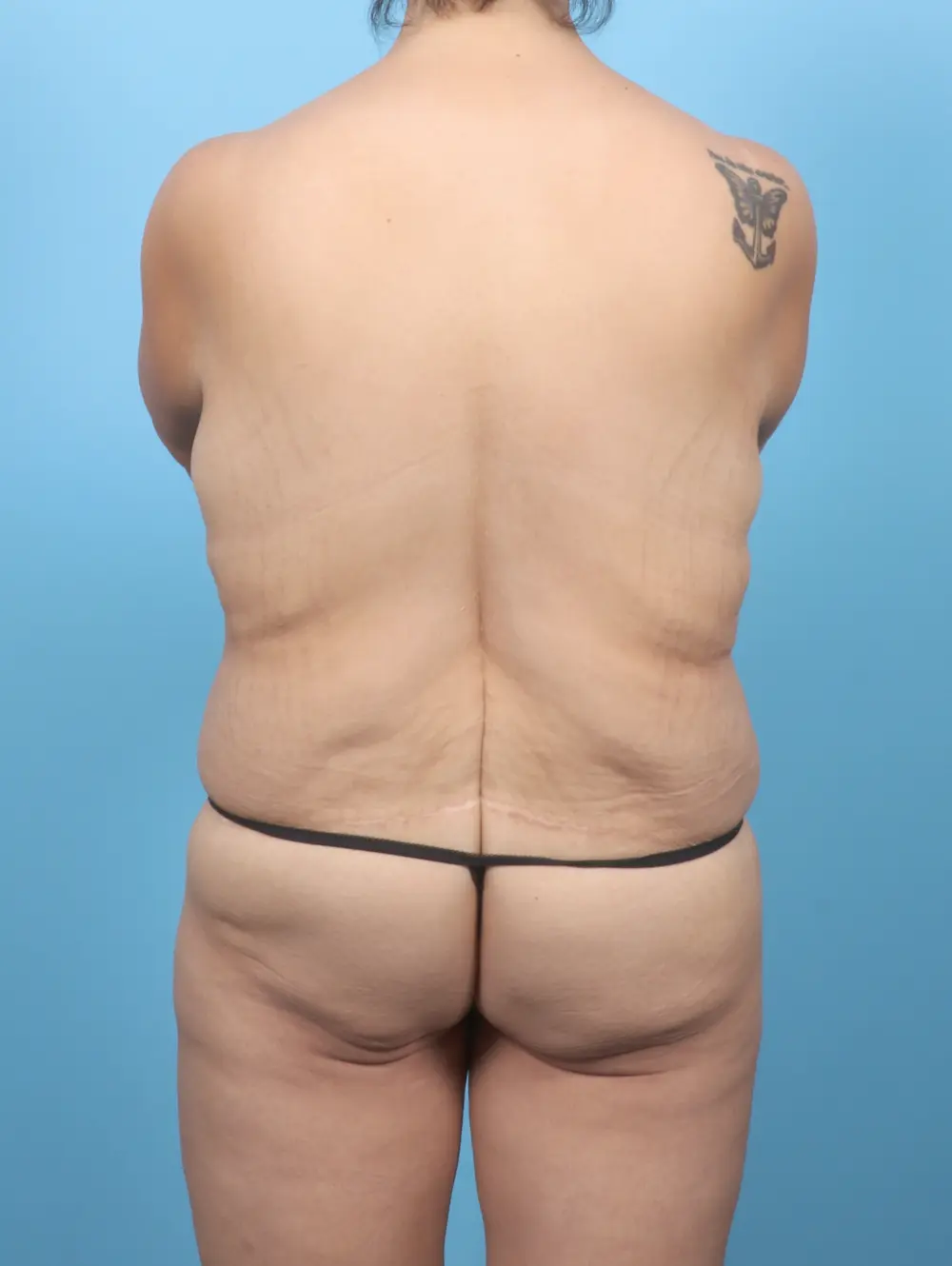 After Weight Loss Patient Photo - Case 54801 - before view-3