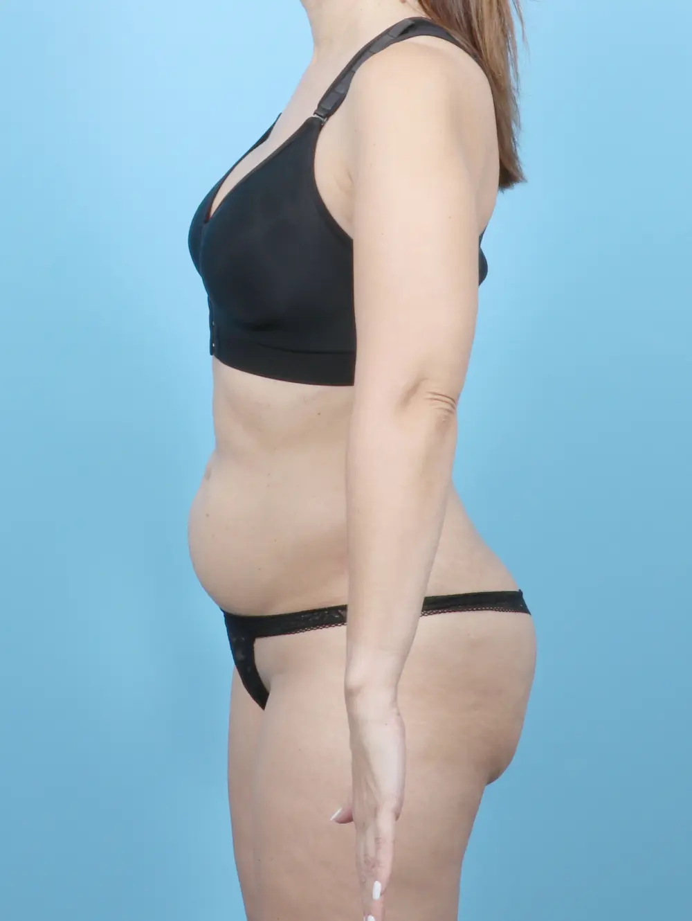 Tummy Tuck Patient Photo - Case 54811 - before view-2