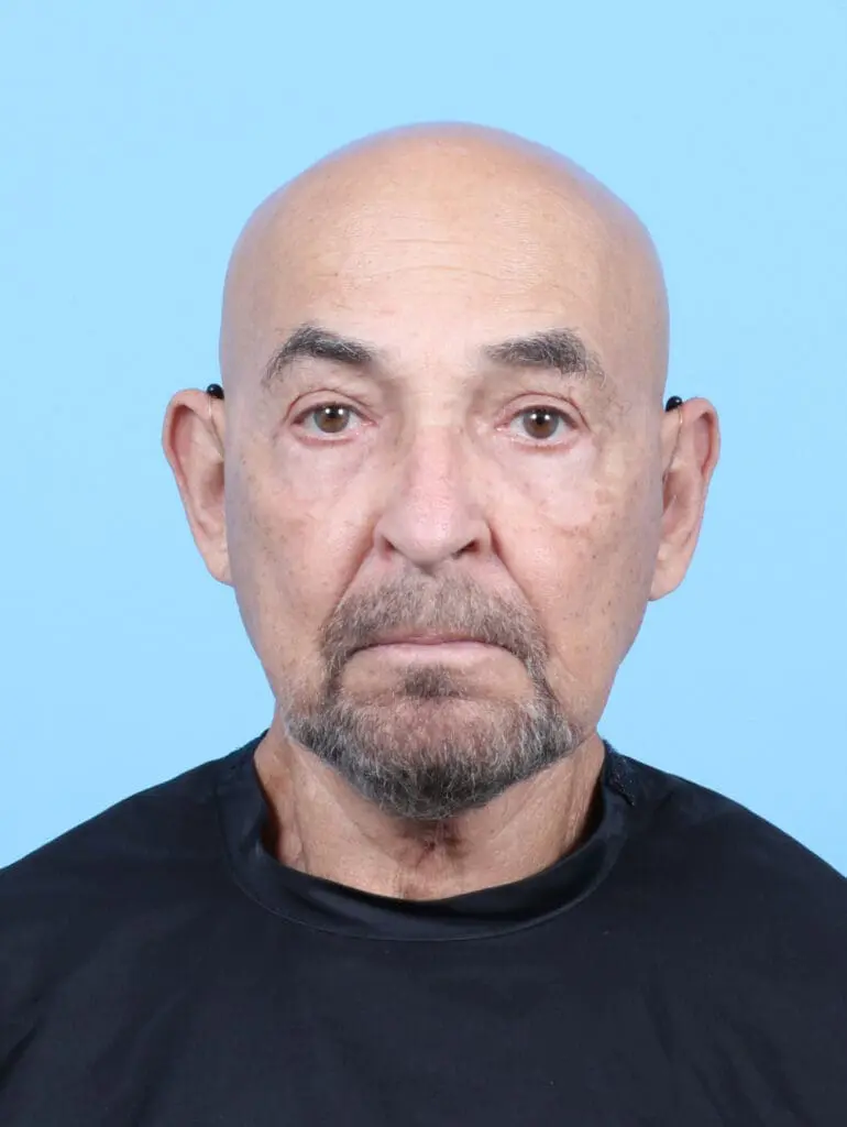 Male Facial Surgery - Case 54827 - After