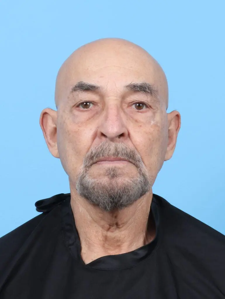 Male Facial Surgery - Case 54827 - Before