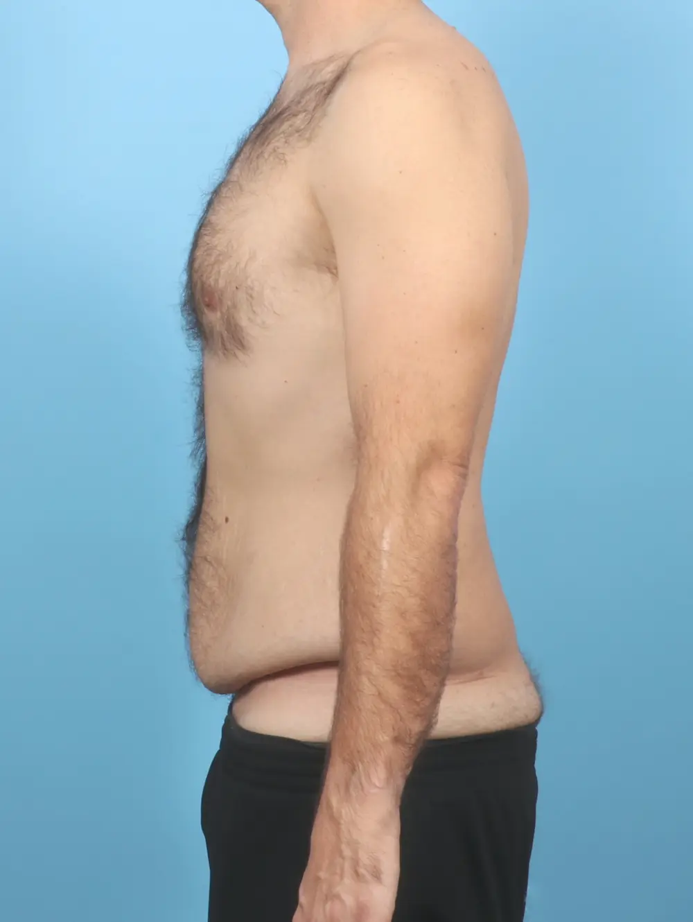 After Weight Loss Patient Photo - Case 54835 - before view-2