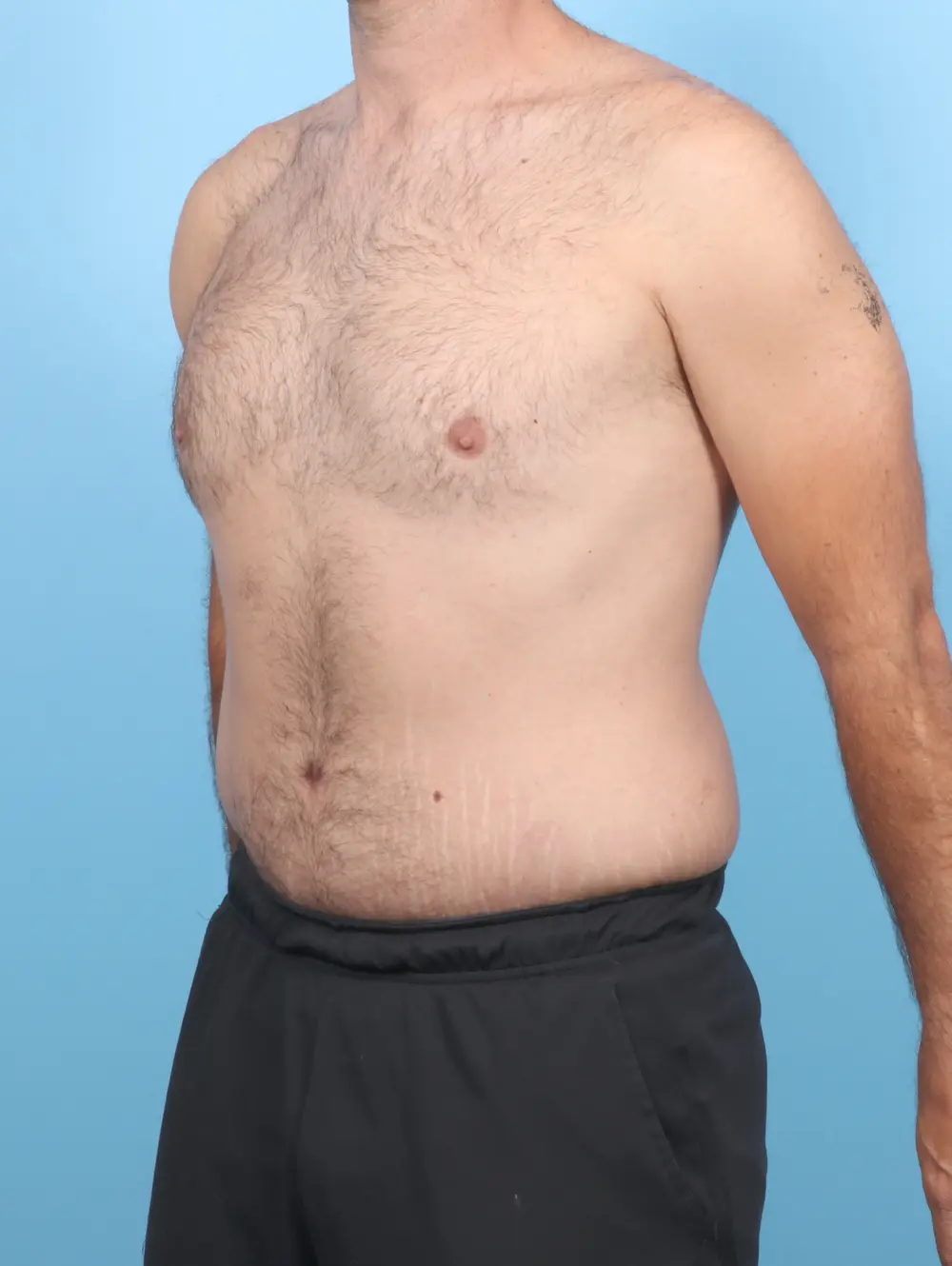 After Weight Loss Patient Photo - Case 54835 - after view-1