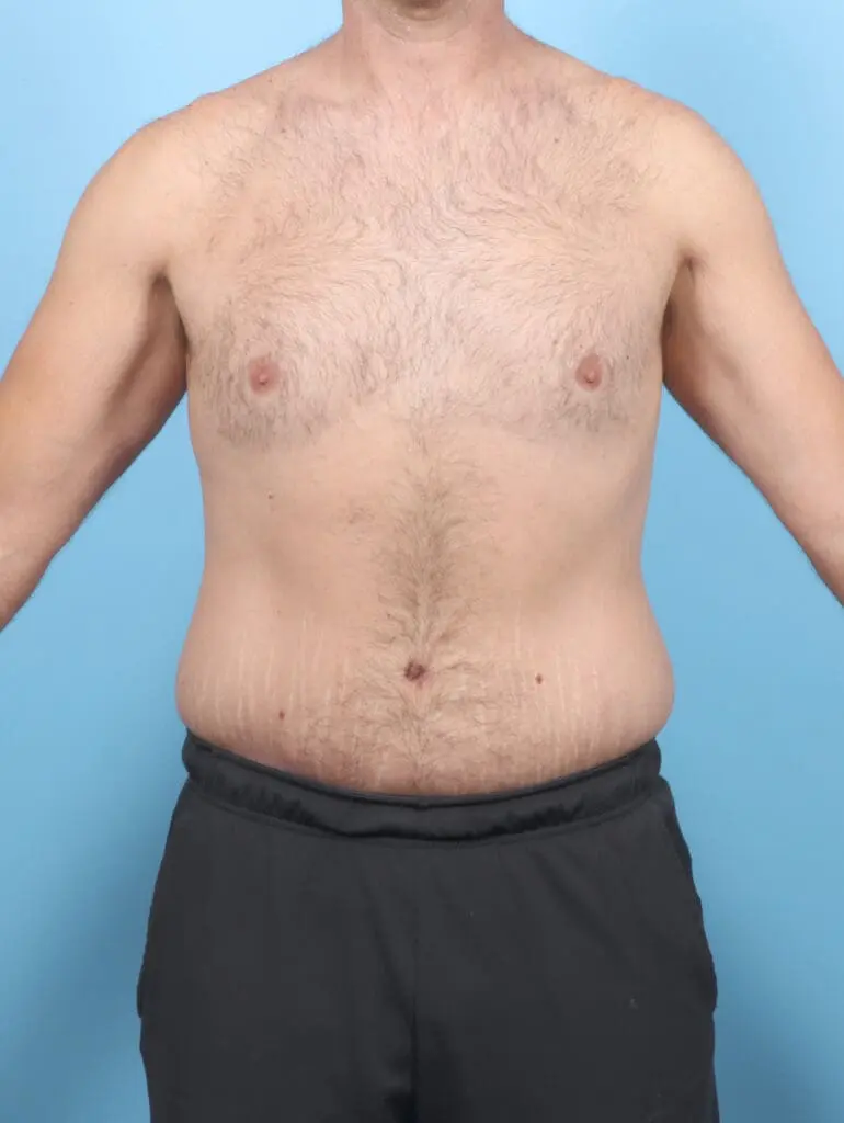 After Weight Loss - Case 54835 - After