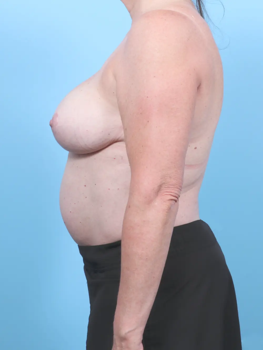 Breast Implant Revision Patient Photo - Case 54851 - after view-2