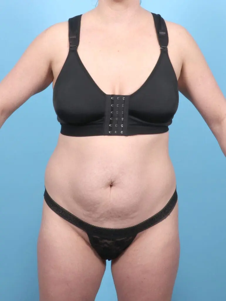 Tummy Tuck - Case 54859 - Before