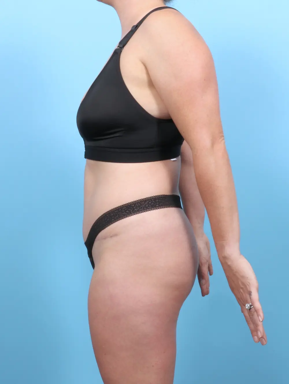 Tummy Tuck Patient Photo - Case 54859 - after view-2