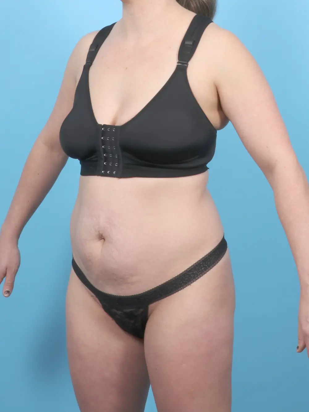 Tummy Tuck Patient Photo - Case 54859 - before view-1