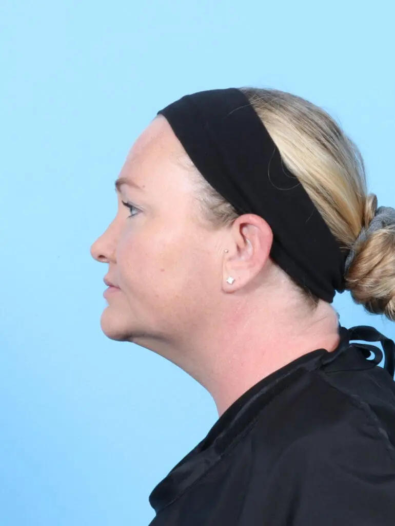 Liposuction - Case 54875 - After