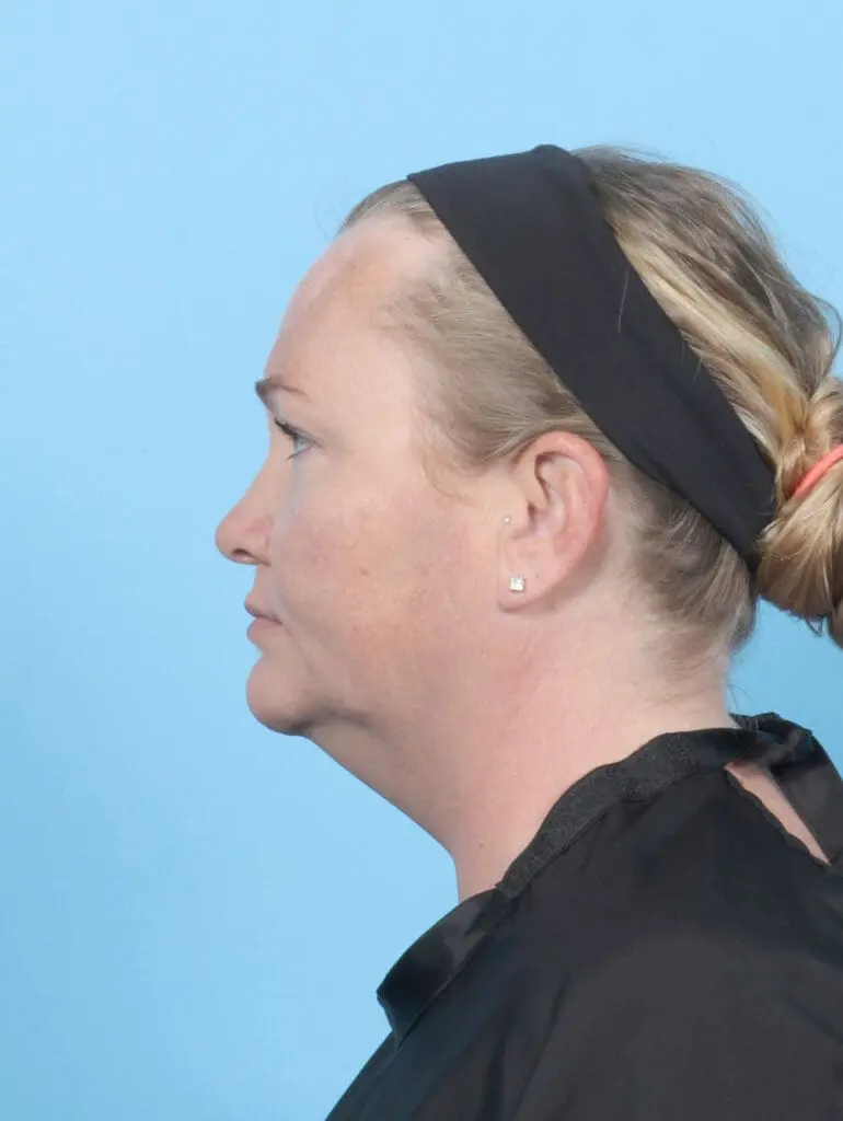 Liposuction - Case 54875 - Before