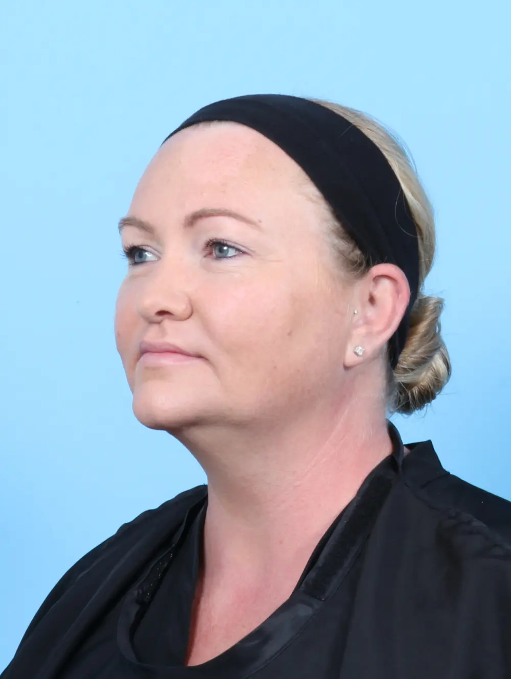 Liposuction Patient Photo - Case 54875 - after view-1