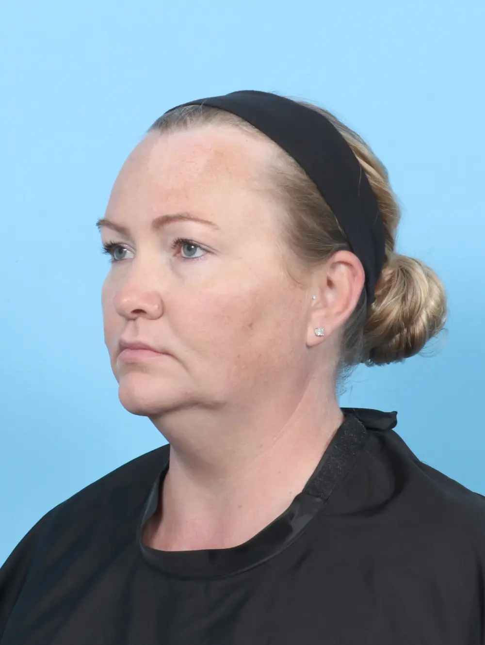 Liposuction Patient Photo - Case 54875 - before view-1