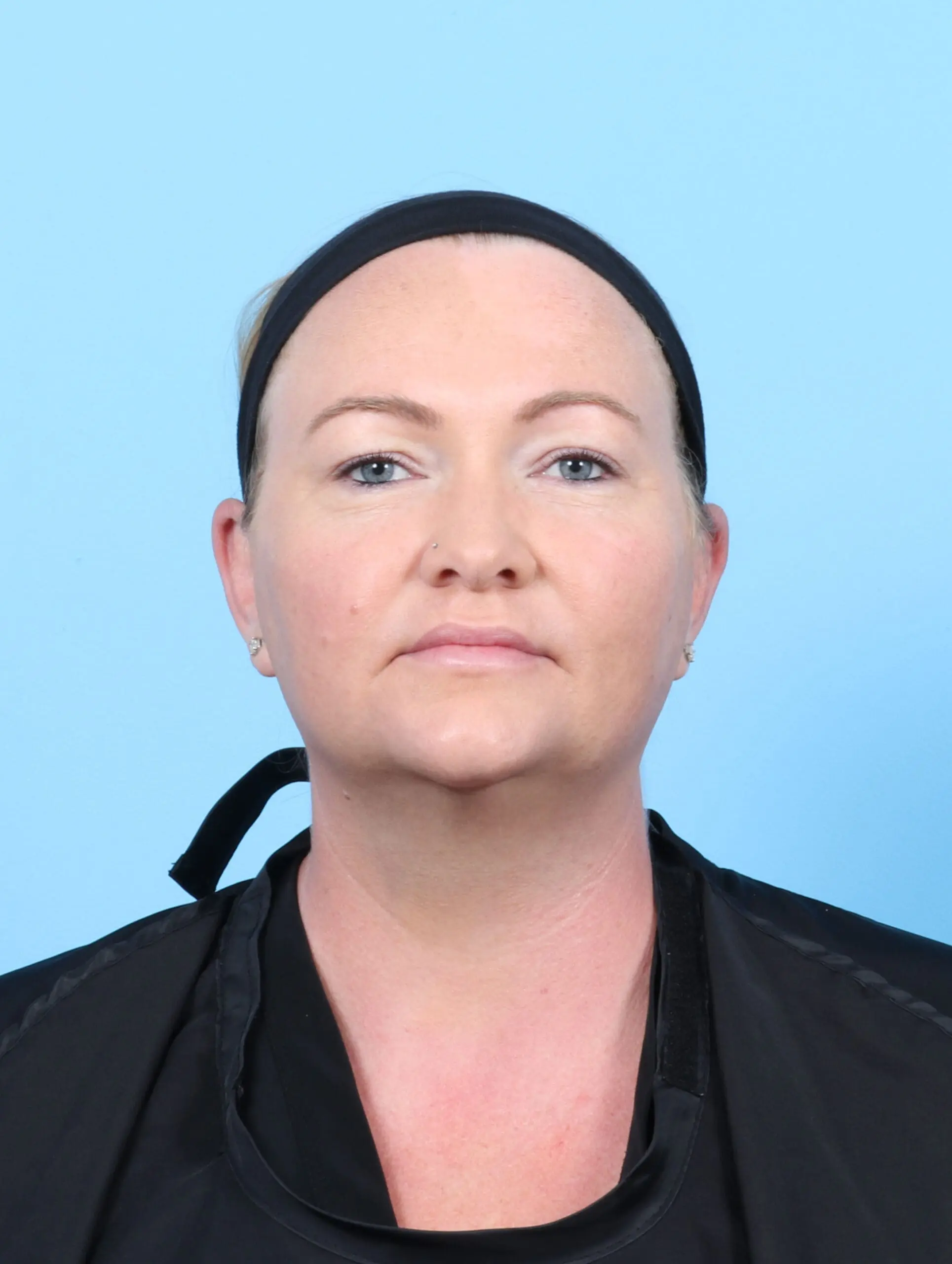 Liposuction Patient Photo - Case 54875 - after view-2