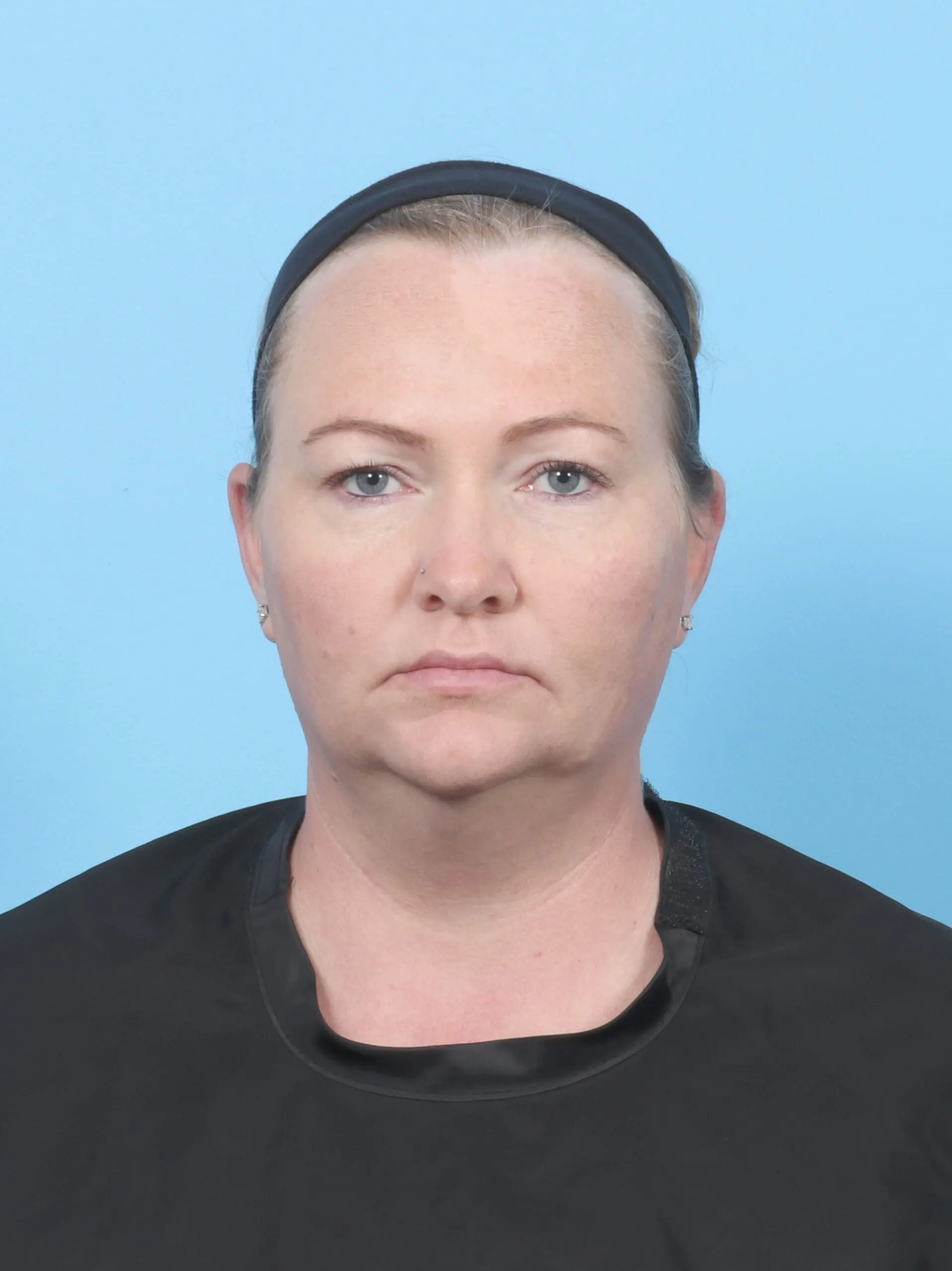 Liposuction Patient Photo - Case 54875 - before view-2