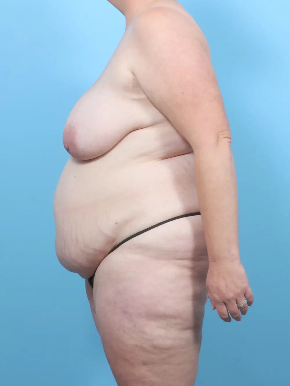 Breast Lift/Reduction with Implants Patient Photo - Case 54883 - before view-2