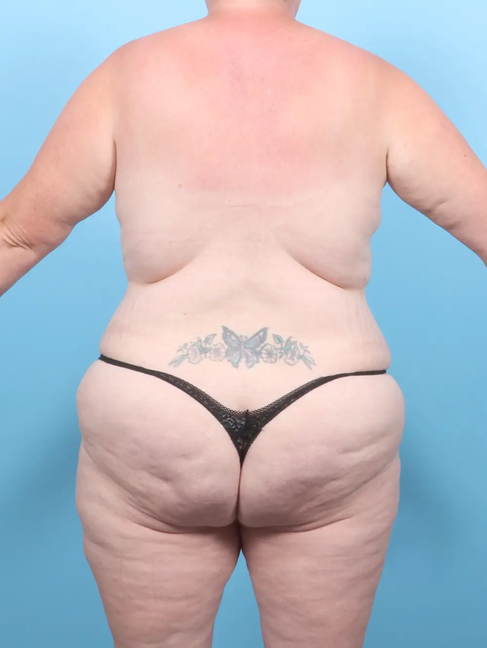 Breast Lift/Reduction with Implants Patient Photo - Case 54883 - after view-3