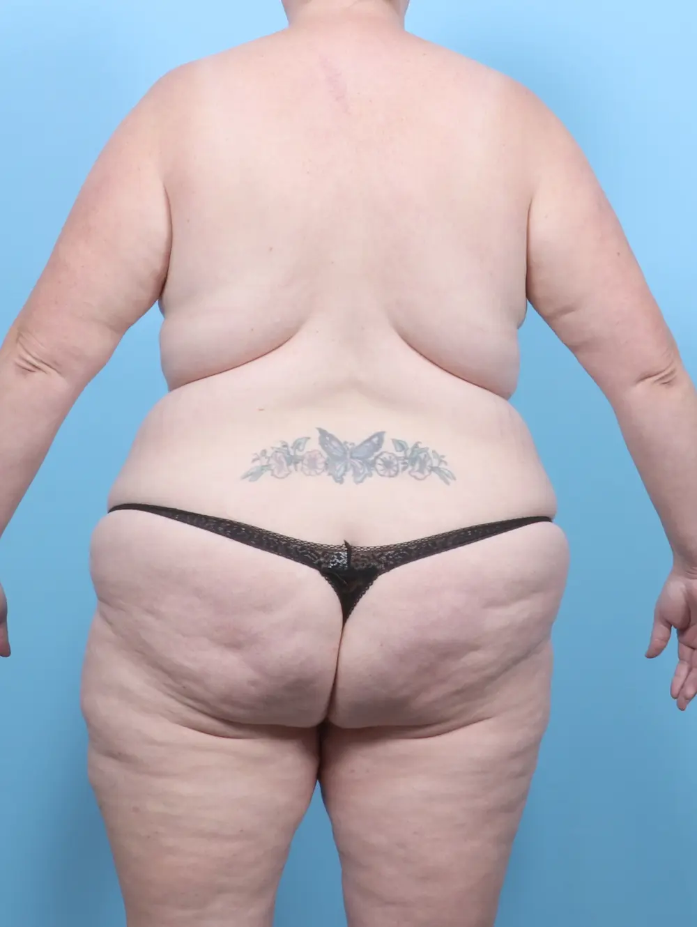 Breast Lift/Reduction with Implants Patient Photo - Case 54883 - before view-3