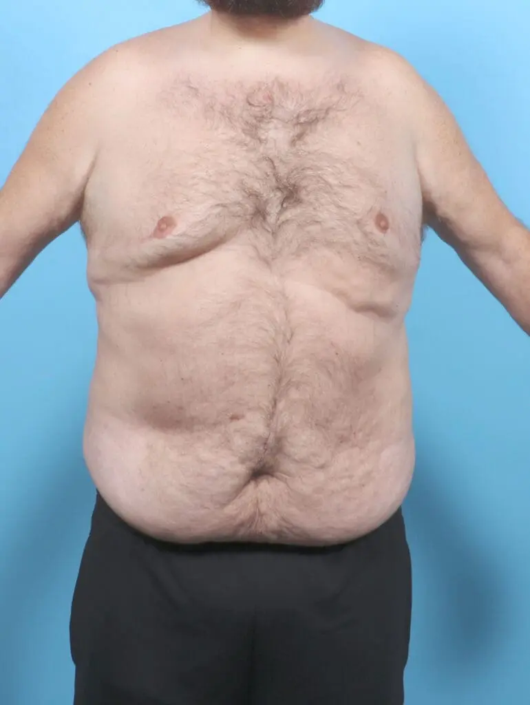 Male Tummy Tuck - Case 54893 - Before
