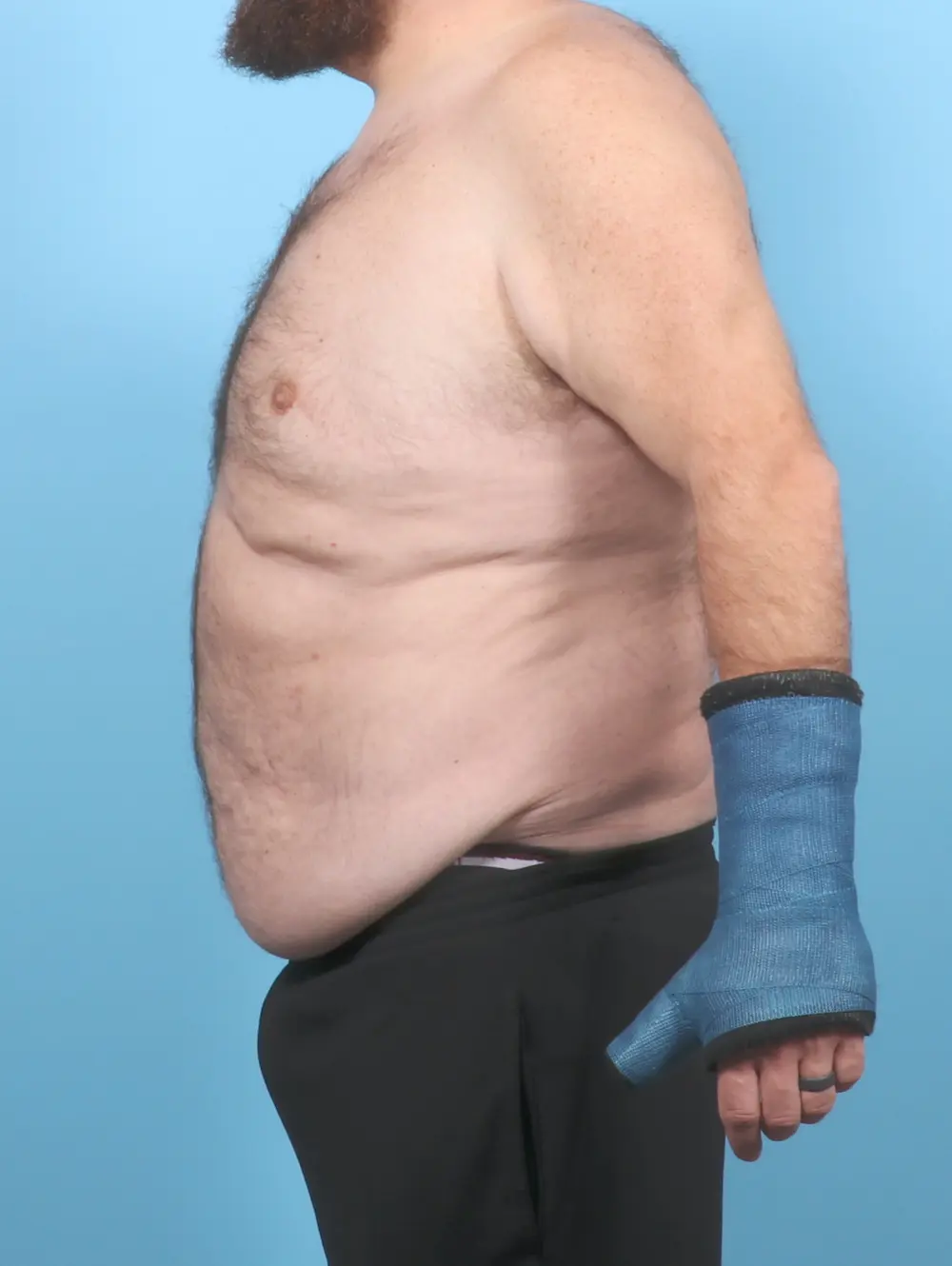 Male Tummy Tuck Patient Photo - Case 54893 - before view-2